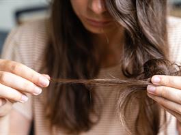 Calvicie femenina: causas y tratamientos