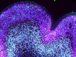 Describen cómo el síndrome de Down altera el desarrollo del cerebro antes de nacer Describen cómo el síndrome de Down altera el desarrollo del cerebro antes de nacer