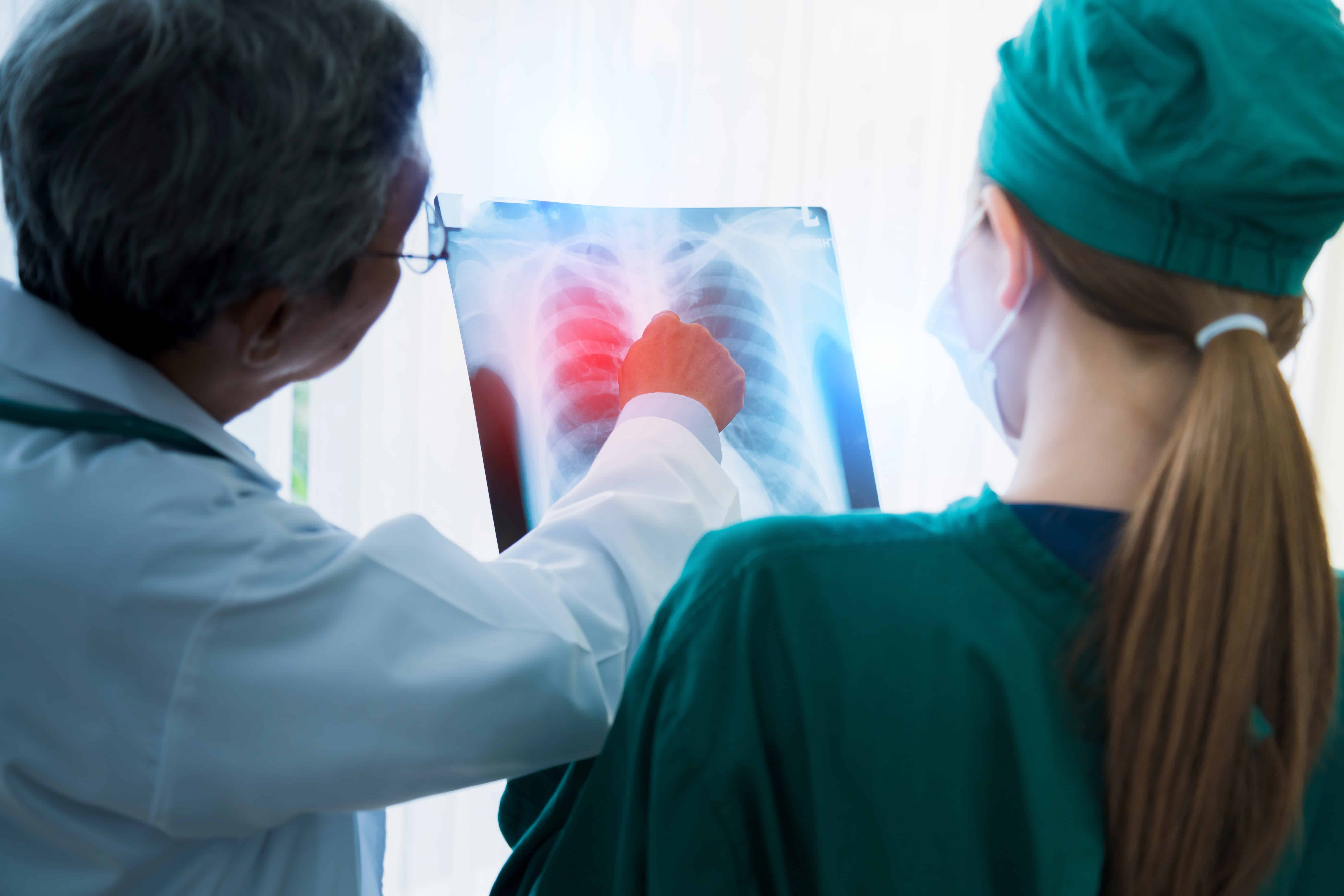 Cáncer pulmonar: la importancia del diagnóstico precoz Cáncer pulmonar: la importancia del diagnóstico precoz